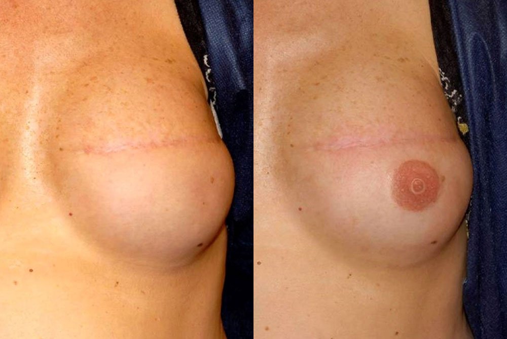 Micropigmentazione areola mammaria